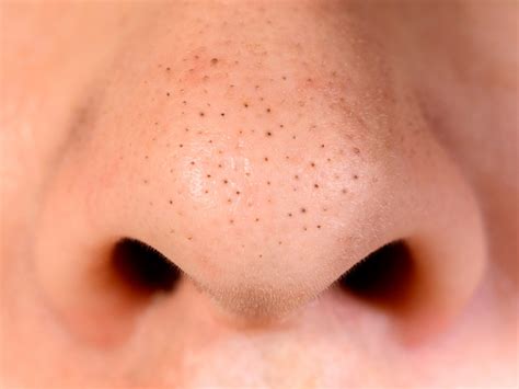 How To Get Rid Of Blackhead Holes On Nose A Pictures Of Hole 2018