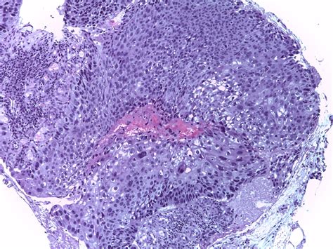 Carcinoma is a malignancy that develops from epithelial cells. apatologica: Carcinoma escamoso