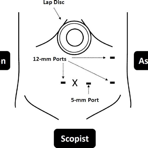 Intraoperative View Of Ports And Incision Locations On The Abdomen 11