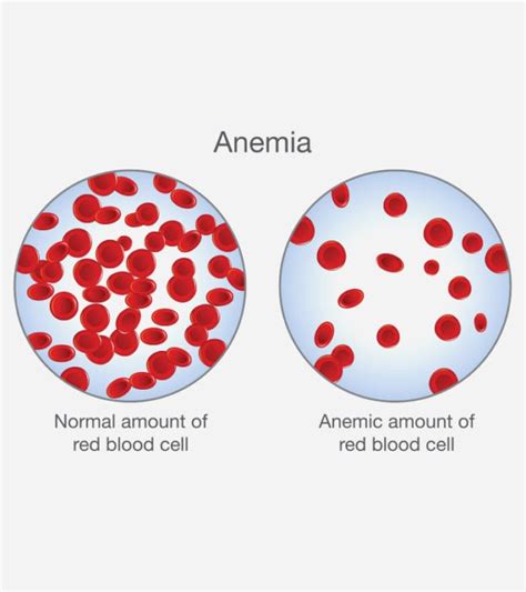 Anemia In Children Types Symptoms Causes And Treatment An Tâm