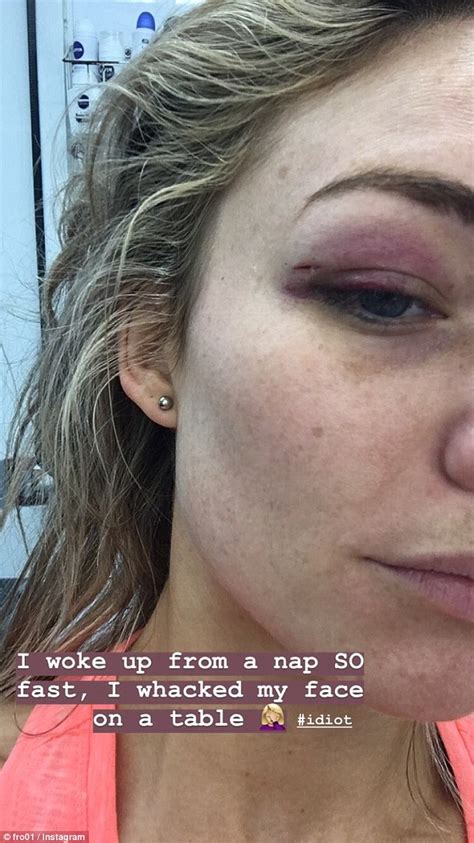 Home And Away Star Sam Frost Shares Image Of Her Brutal Black Eye Injury Daily Mail Online