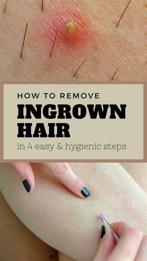 How To Remove Ingrown Hair In Easy And Hygienic Steps Ingrown Hair Hygienic