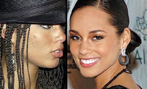 10 Beautiful Celebrities With Surprising Acne Scars