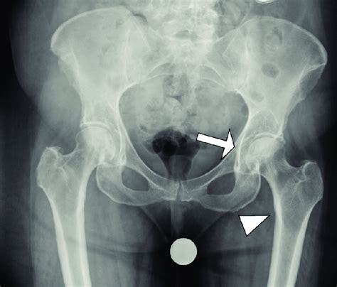 Anteroposterior Ap X Ray Of The Hips Demonstrating Degenerative