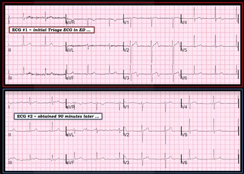 Dr Smith S ECG Blog Dynamic Reversible Ischemic T Wave Inversion
