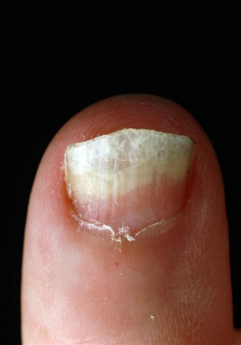 Infected Finger Nail Photos Cantik