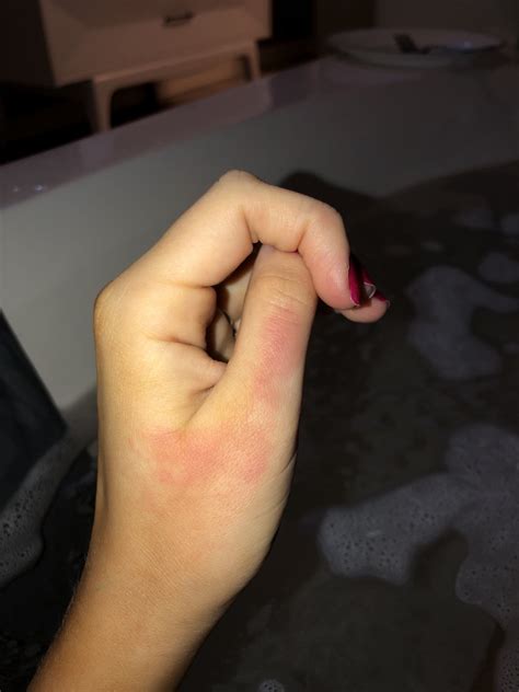 Weird Rash On Handscould It Be An Early Pregnancy Sign Or Is It