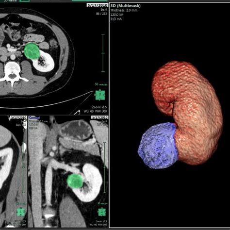 Synapse 3d Renal Mass Segmentation The Segmented Region Of Interest Is