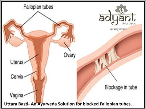 Ayurveda Treatment For Blocked Fallopian Tubes Adyant Ayurveda