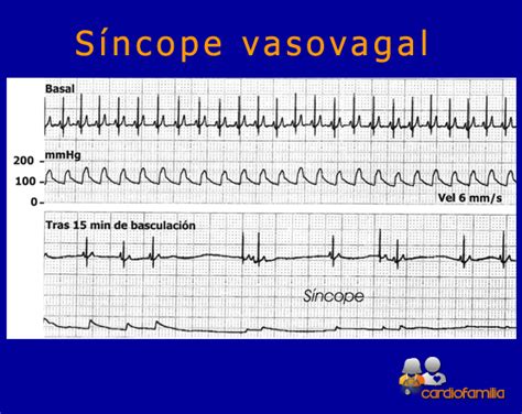 Reflex syncope is divided into three types: Opiniones de sincope vasovagal