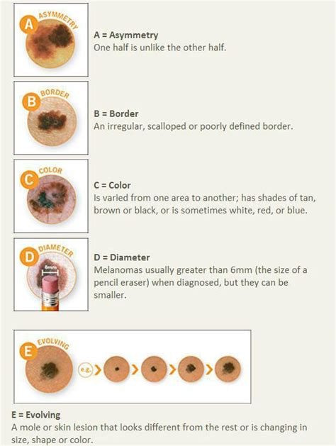 Jim's melanoma skin cancer photos & treatment options. Detecting melanoma