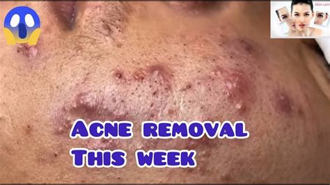 Cystic Acne Extraction This Week Blackheads Removal Youtube