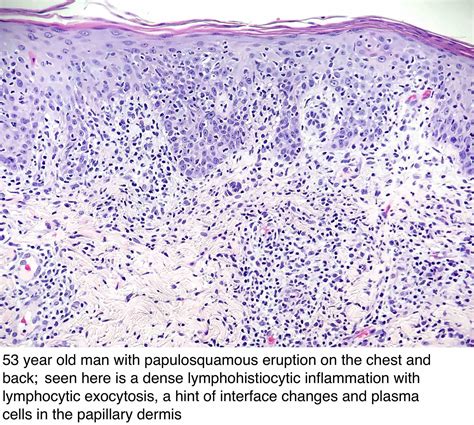 Jun 07, 2017 · what is syphilis? Pathology Outlines - Syphilis