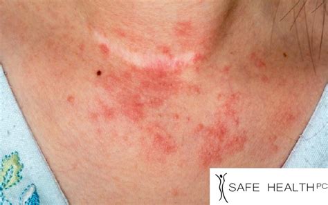 Atopic Dermatitis And Eczema Treatment Safe Health And Med Spa