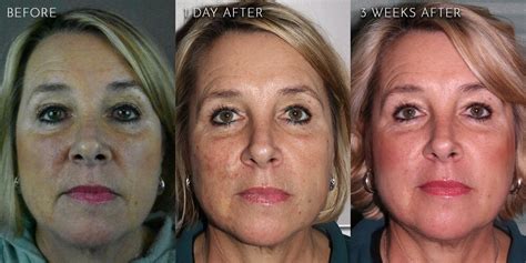 Amazing Transformation See Before And After Under Eye Thread Lift