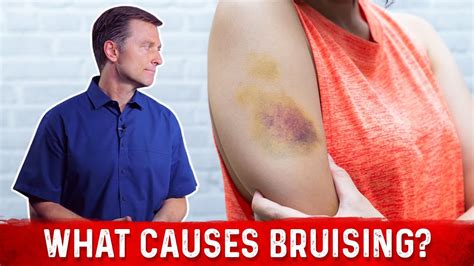 What Causes Bruising Without Trauma And Its Treatment Drberg Answers