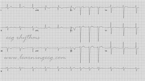 It may be due to progressive fatigue of av nodal cells as. ECG Rhythms: Is this Complete Heart Block?