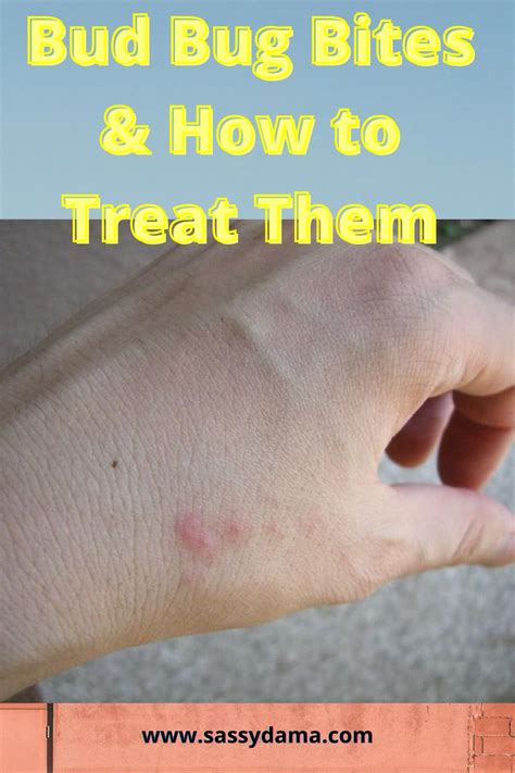 How To Effectively Treat Bed Bug Bite And Infestation Bed Bug Bites