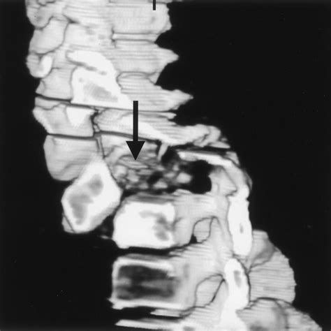 Plain Radiograph Of The Cervical Spine Demonstrating The Collapse Of C7
