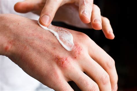 5 Tips To Prevent Eczema Flare Ups Garden City Ny And Syosset Ny