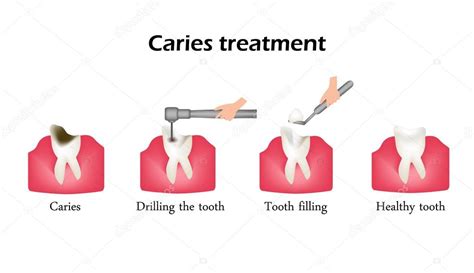 Our vets and support staff have the experience and expertise to provide the best care that is right for your pet. Behandlung von Karies. Bohren einen Zahn. Versiegelung des ...
