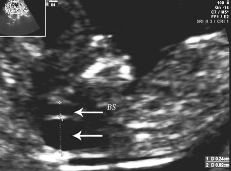 Appearance Of Fetal Posterior Fossa At 1114 Weeks In Fetuses With