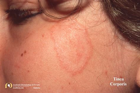 Tinea Corporis Ringworm Tinea Circinata Academic Dermatology Of