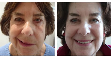 Bell's palsy improves without treatment. CACI for Bell's palsy | Melior Clinics