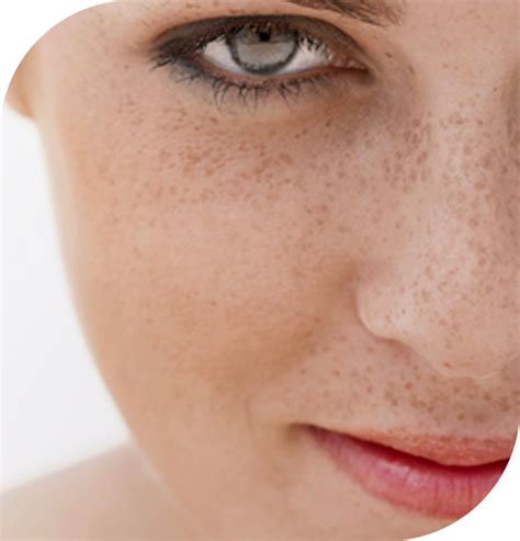 Freckles Cosmetic Dermatology Dr Sn Wong Skin Clinic
