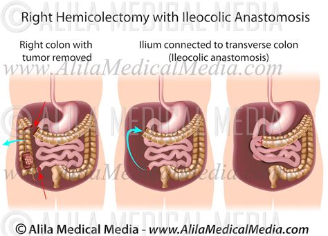Right Hemicolectomy With Ileocolic Anastomosis Alila Medical Images