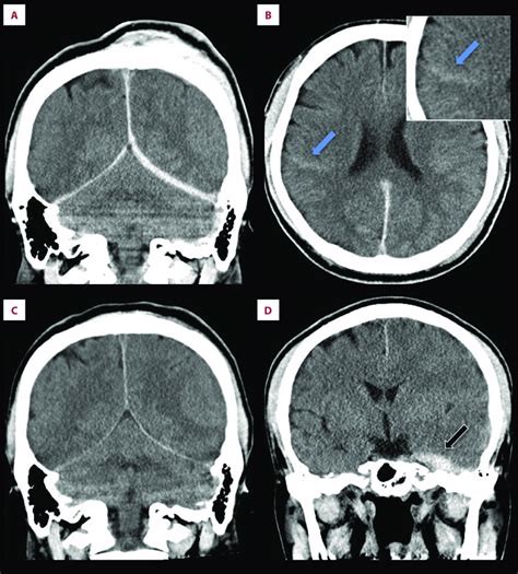 Coronal Computed Tomography CT Shows Subdural Hematoma SDH At The Download Scientific