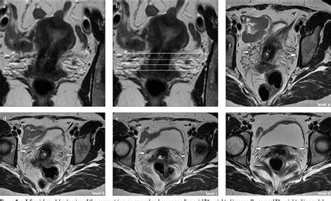 Figure 4 From Mri Anatomy Of Parametrial Extension To Better Identify