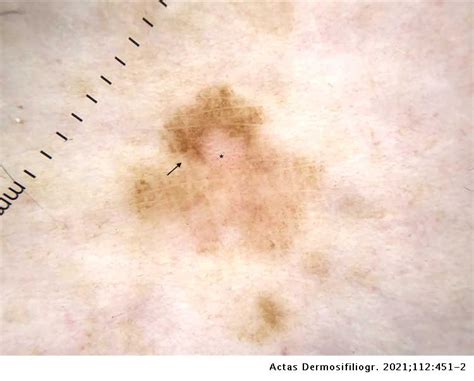 Prominent Skin Markings A New Reason To Suspect Melanoma Actas Dermo