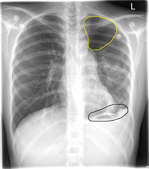 Doctors use them to diagnose problems. Endometriosis chest x ray - wikidoc