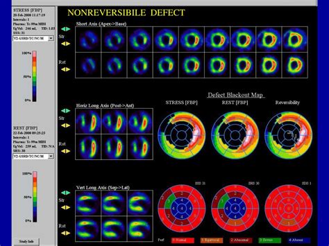 Ppt Nuclear Cardiac Imaging Kmichalová Powerpoint Presentation Free