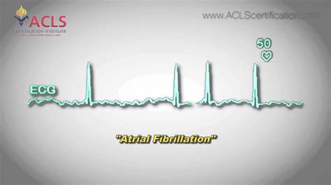 Atrial Fibrillation Afib By Acls Certification Institute Youtube