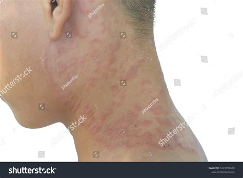 Fungal Rash On Neck