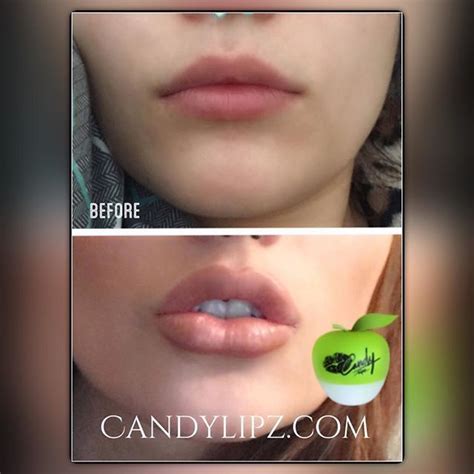 If You Love Angelina Jolie Lips Look At These Incredible Results They