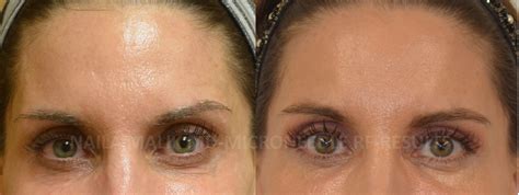 Genius Microneedling Before And After Before And After