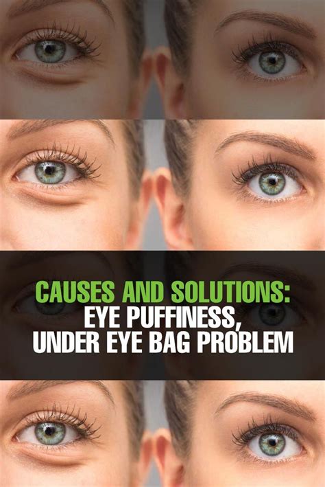You Should Know About Causes And Solutions Of Eye Puffiness Puffy