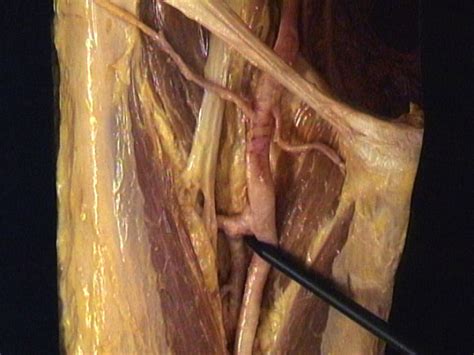 Arteries of the hip region | Acland's Video Atlas of Human Anatomy