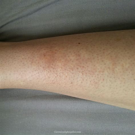 Histamine Intolerance How Im Reducing My Rashes And Hives