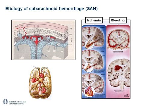 Pathophysiology Of Subarachnoid Brain Hemorrhage Bodossaki Lectures