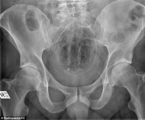 Doctors Share X Rays Of The Strangest Things They Ve Found Stuck In