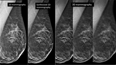 Effect Of Integrating Digital Breast Tomosynthesis 3d Mammography