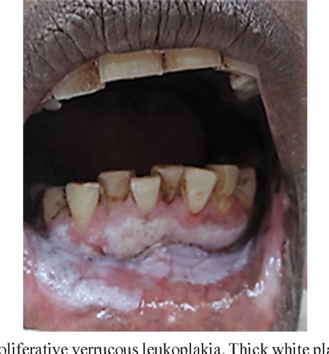 Figure 6 From Oral Health Consequences Of Smokeless Tobacco Use
