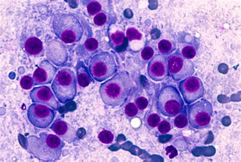 Inherited Gene Mutation Increases Risk Of Blood Cancer Newsroom
