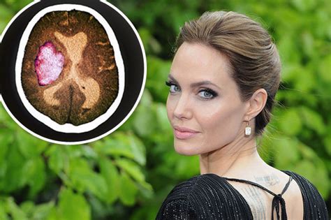 Aug 06, 2021 at 4:41 pm. Angelina Jolie reveals she has Bell's palsy - here are the ...
