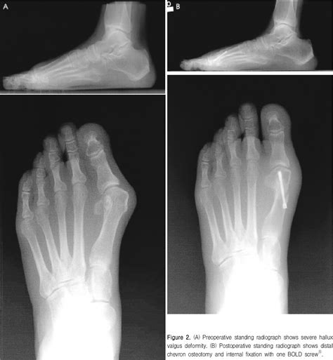 Distal Chevron Osteotomy With One Bold Screw Fixation In Hallux Valgus