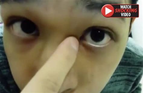 Cyst Popping Video Pus Oozes From Mans Eye After Pimple Squeezed